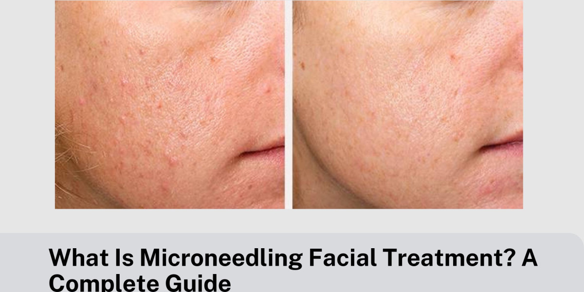 What Is Microneedling Facial Treatment? A Complete Guide